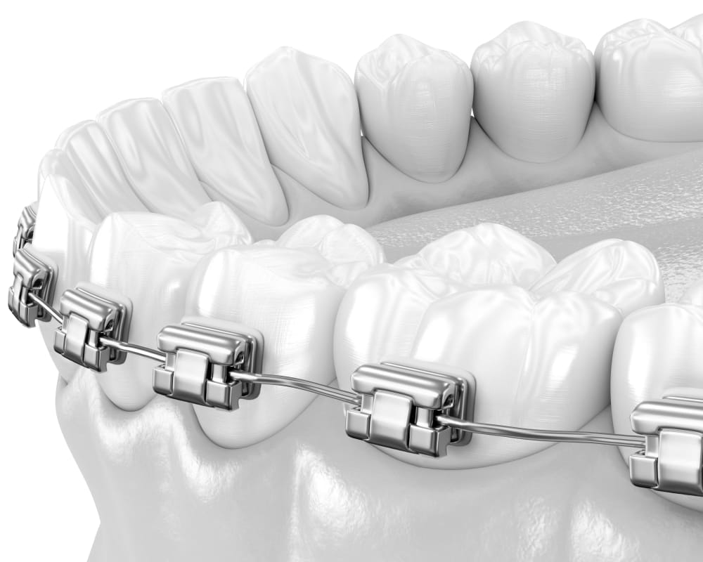 Self-litigating braces use a built in mechanism to hold the arch wire in place.