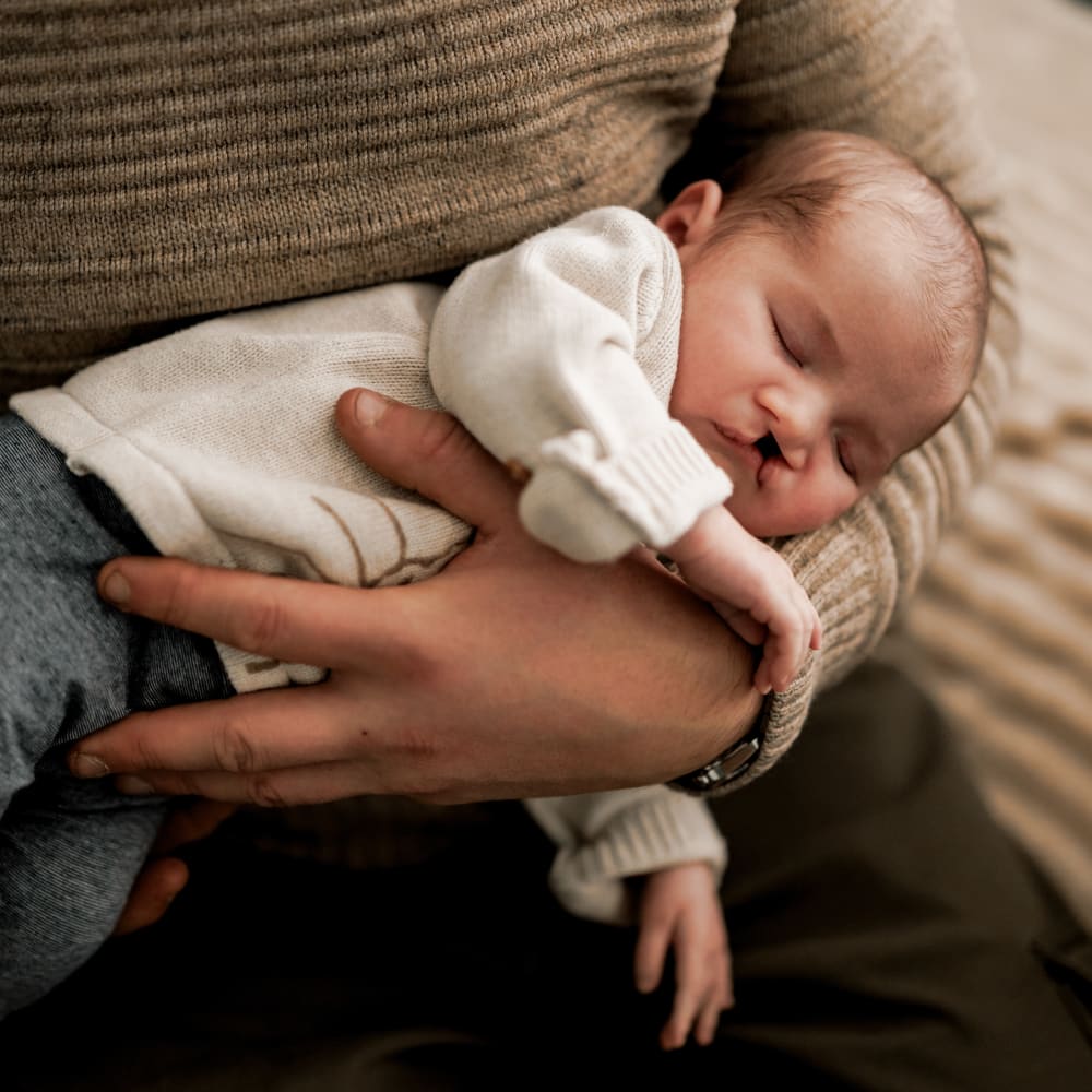 A baby with a cleft lip and palate peacefully sleeps in the arms of a parent.